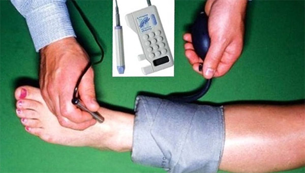 Ankle Brachial Index